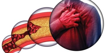 أطعمة تضر مرضى الكوليسترول