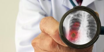 «السلفورافان» يخفض تلف الرئة بكورونا 29 %